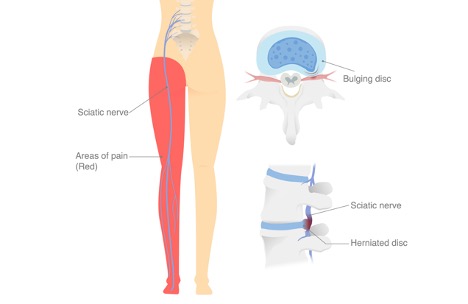 A picture containing Sciatica nerve, bulging disc, herniated disc